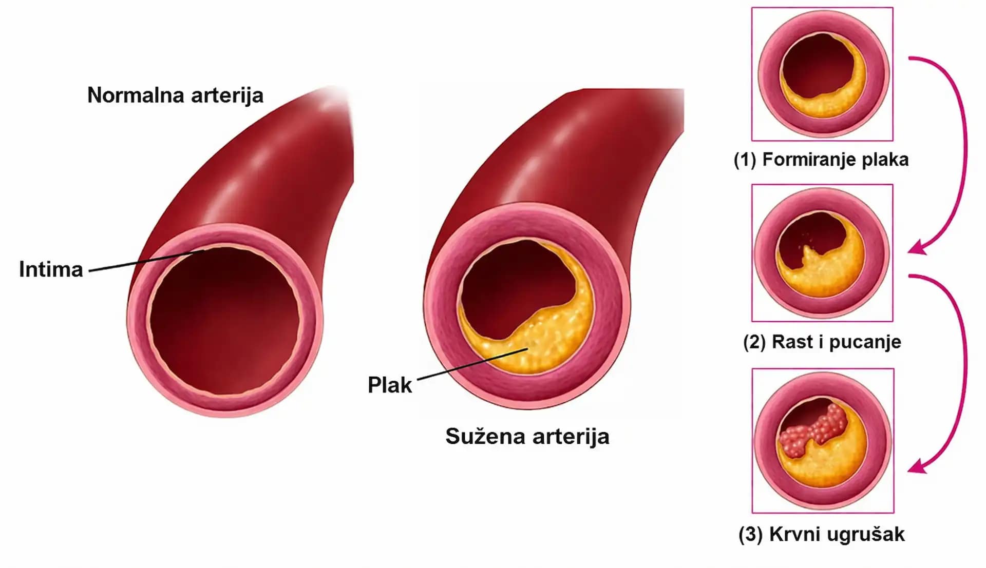 plak u arterijama suzena arterija razlika zdrava i zacepljena arterija